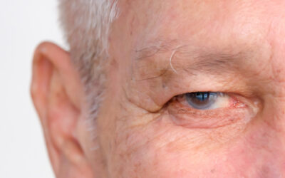 What Is Glaucoma?