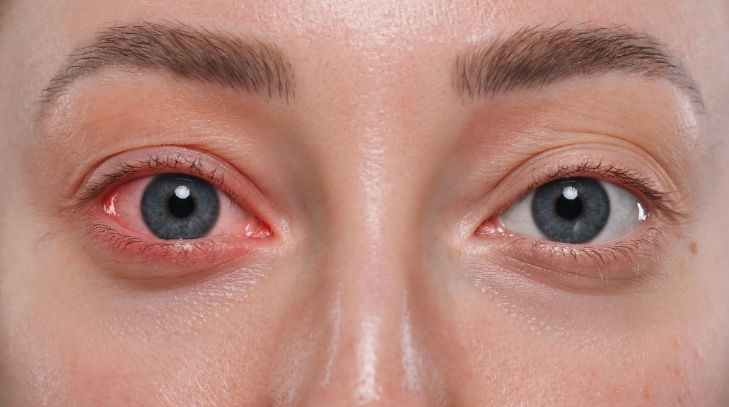 Close of of woman's face and eyes which shows she has amblyopia 