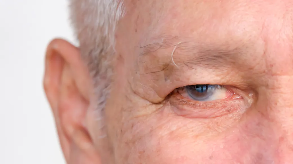 What Is Glaucoma?
