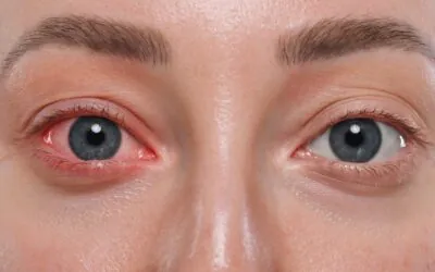 What Is Conjunctivitis (Pink Eye)?
